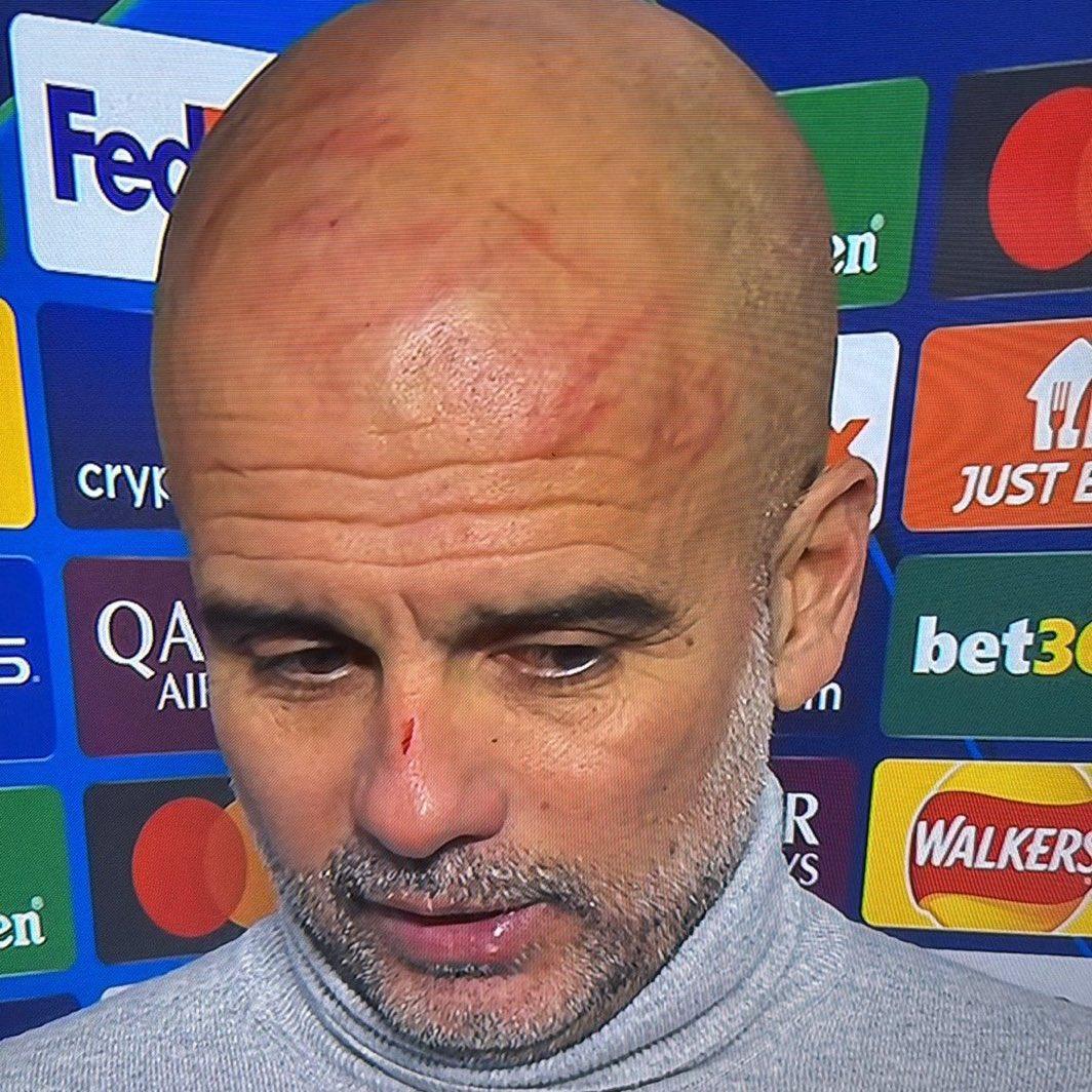 Guardiola shock, in tv con graffi in testa e sul naso: “Mi sono auto flagellato” – FOTO